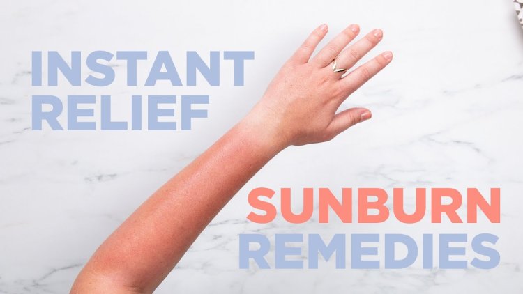 Sunburn Relief Natural Remedies: Calming Solutions for Sunburned Skin