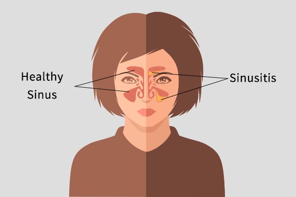 Understanding and Handling Sinus Problems: The Relationship Between Sinusitis and ENT Health