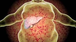 Fatty Liver Disease: Causes, Prevention, and Management